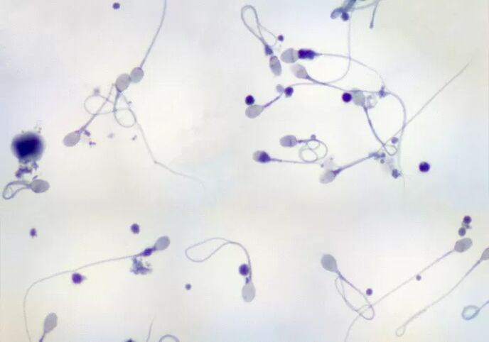 Oligozoospermia was diagnosed - low sperm count